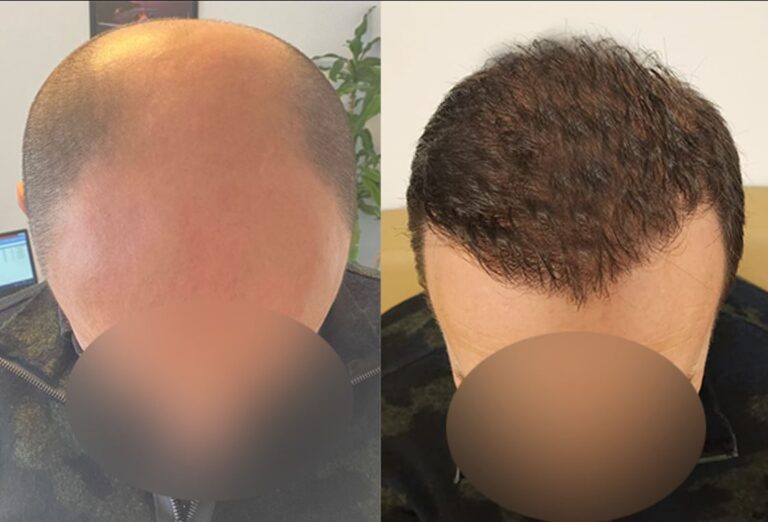 5900 grafts implanted by our medical team through FUE technique (9-month result)