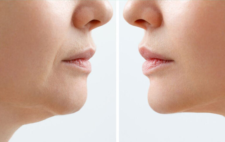 Mild interventions of face lift will make you look younger, without any loss of naturality.