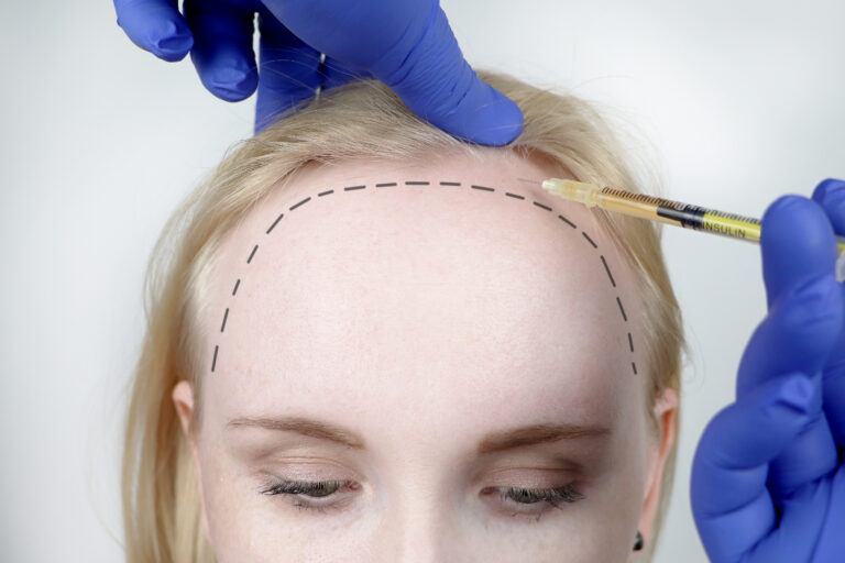А beautician doctor makes injections in the head of a woman for hair growth or to prevent baldness. Hair mesotherapy or hair transplant.