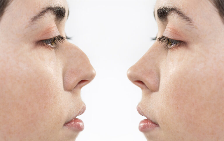 A significant change is possible through a rhinoplasty surgery.