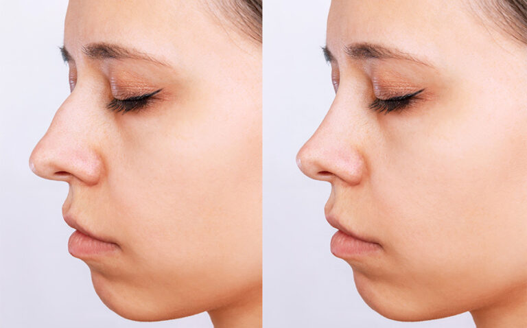 An important factor is that your reshaped nose matches well with your face.
